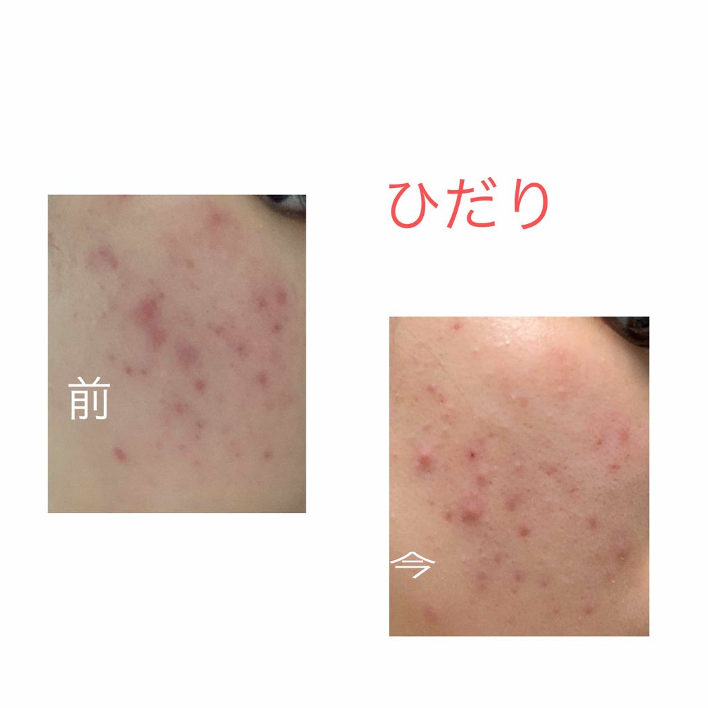 ハトムギ化粧水(ナチュリエ スキンコンディショナー R )/ナチュリエ/化粧水を使ったクチコミ（2枚目）