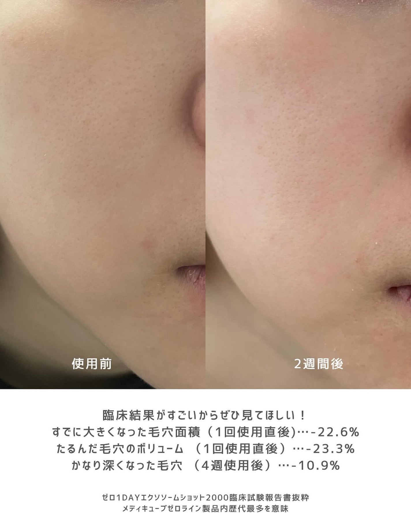 ゼロ1DAYエクソソームショット2000/MEDICUBE/美容液を使ったクチコミ(4枚目)