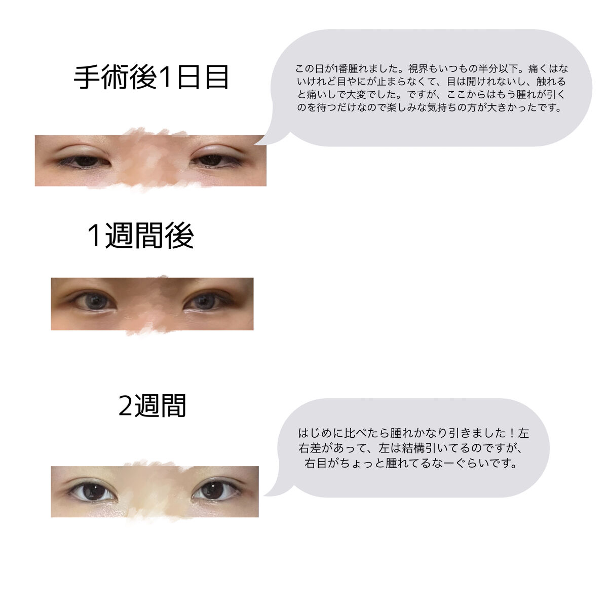 二重整形/その他を使ったクチコミ（3枚目）