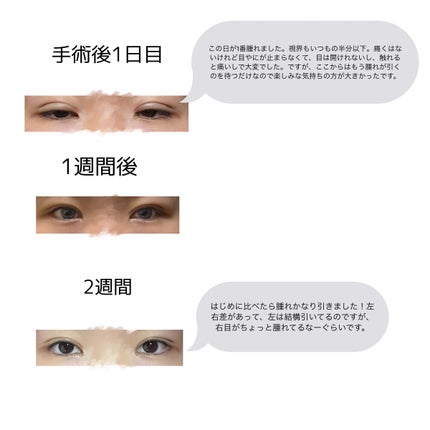 二重整形/その他を使ったクチコミ(3枚目)