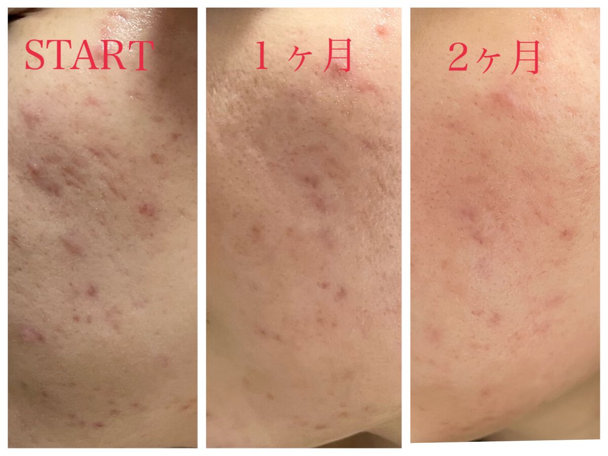 レチノールA 1% アドバンスドリバイタリゼーションクリーム/Life-flo/フェイスクリームを使ったクチコミ(2枚目)