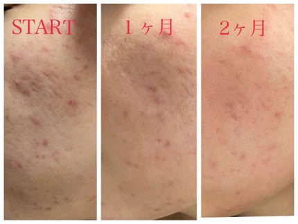 レチノールA 1% アドバンスドリバイタリゼーションクリーム/Life-flo/フェイスクリームを使ったクチコミ(2枚目)