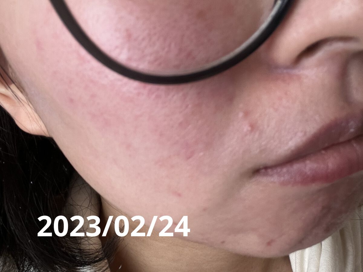 マジックティーツリーオイル/ブラン/フェイスオイルを使ったクチコミ（2枚目）