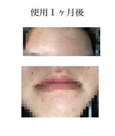 幸子 on LIPS 「皮膚科で貰ったエピデュオゲルを使用して１ヶ月後が経ったので、レ..」（4枚目）