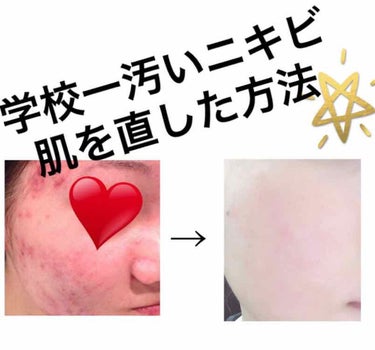 らんちょん on LIPS 「学校一汚いニキビ肌とバイバイした方法👋汚い写真で申し訳ないんで..」（1枚目）