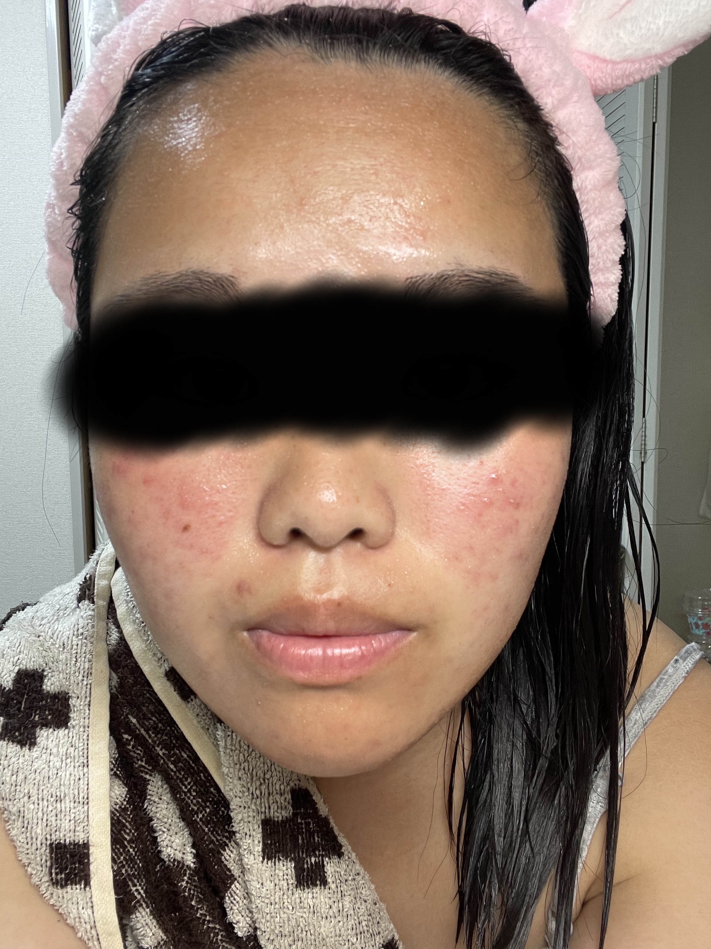 薬用 極潤 スキンコンディショナー/肌ラボ/化粧水を使ったクチコミ（3枚目）