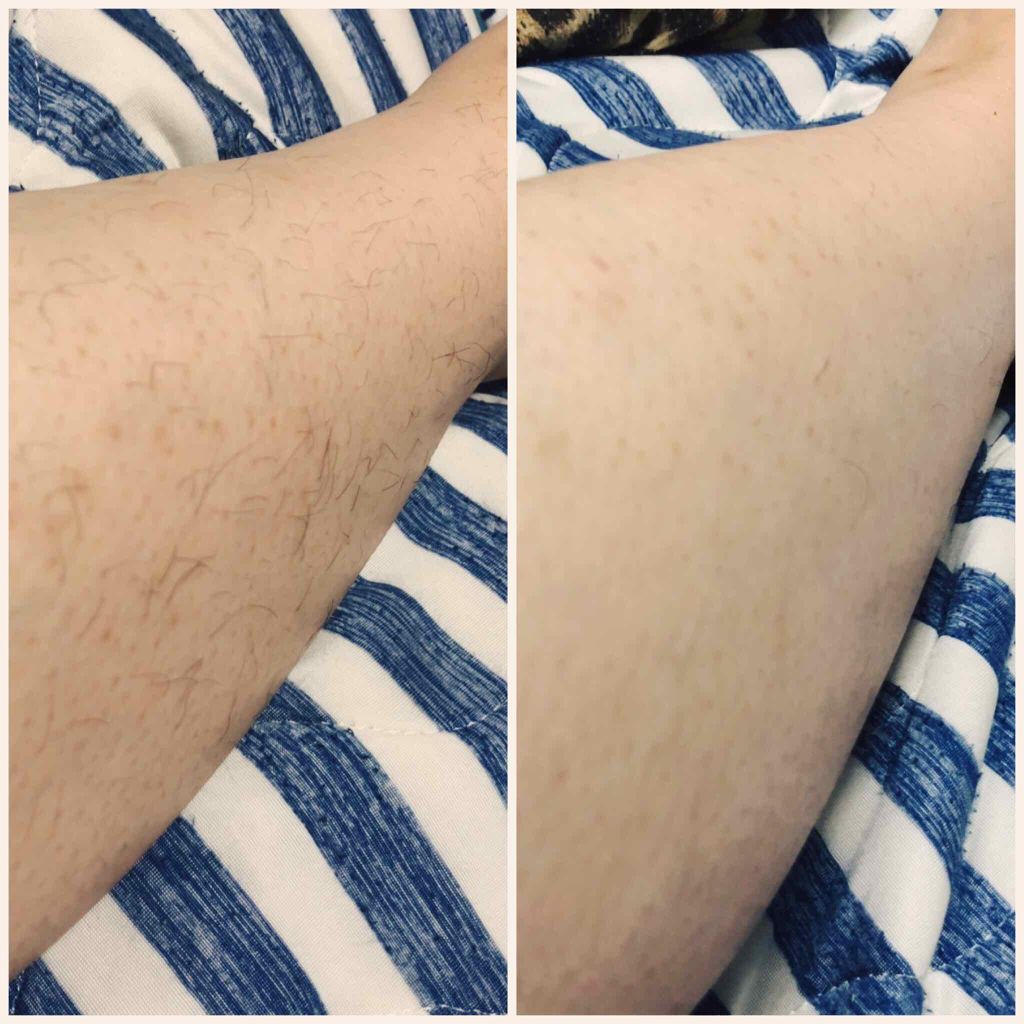 脱毛 ワックスシート/DAISO/除毛クリームを使ったクチコミ(3枚目)