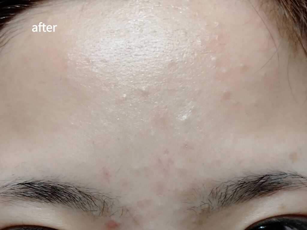 大人のニキビ対策 薬用美白化粧水/肌美精/化粧水を使ったクチコミ（1枚目）