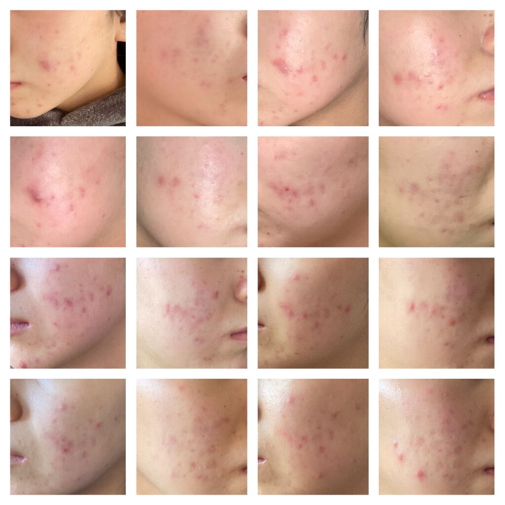 あみ on LIPS 「クロロフィル化粧品を使い始めて、2ヶ月経ちました。左から右に上..」(1枚目)