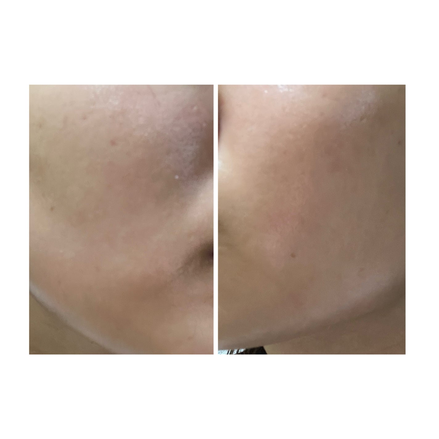 ぽむ on LIPS 「2023.9.13皮膚科に受診 エピデュオとヘパリン処方1枚目..」(5枚目)