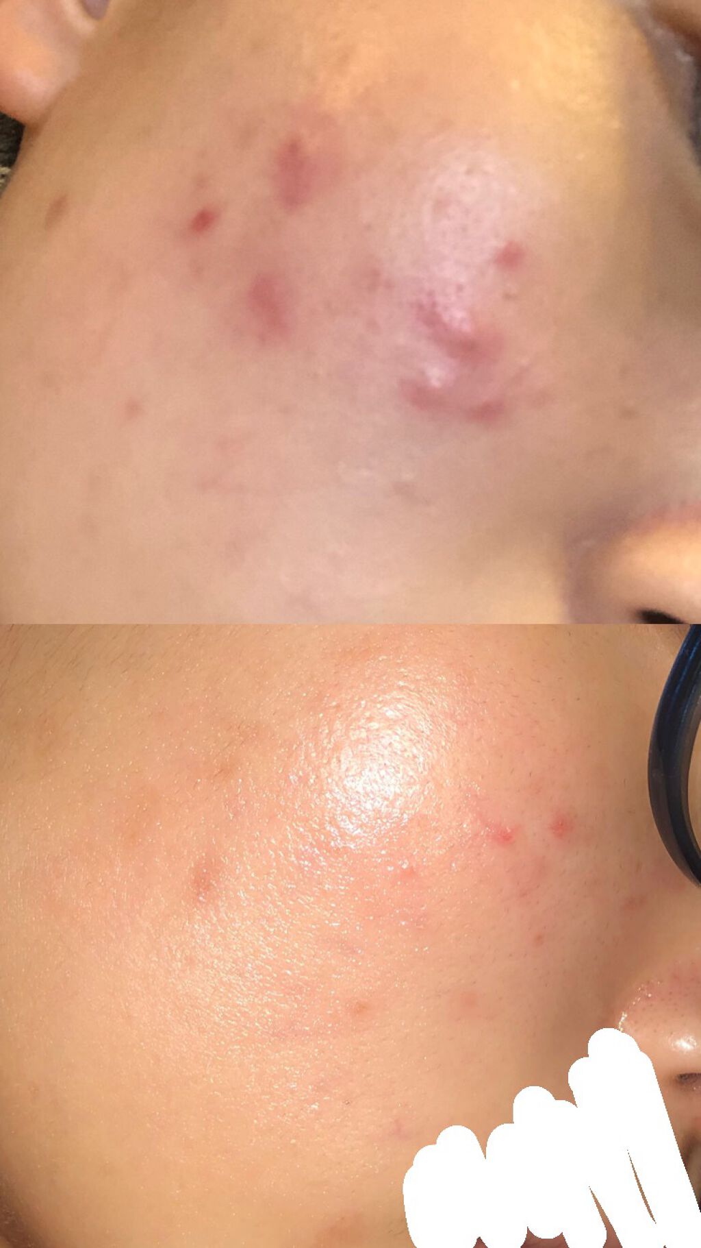 n on LIPS 「記録用...ニキビ治療2ヶ月ちょっと!大分肌が綺麗になってきた..」(1枚目)