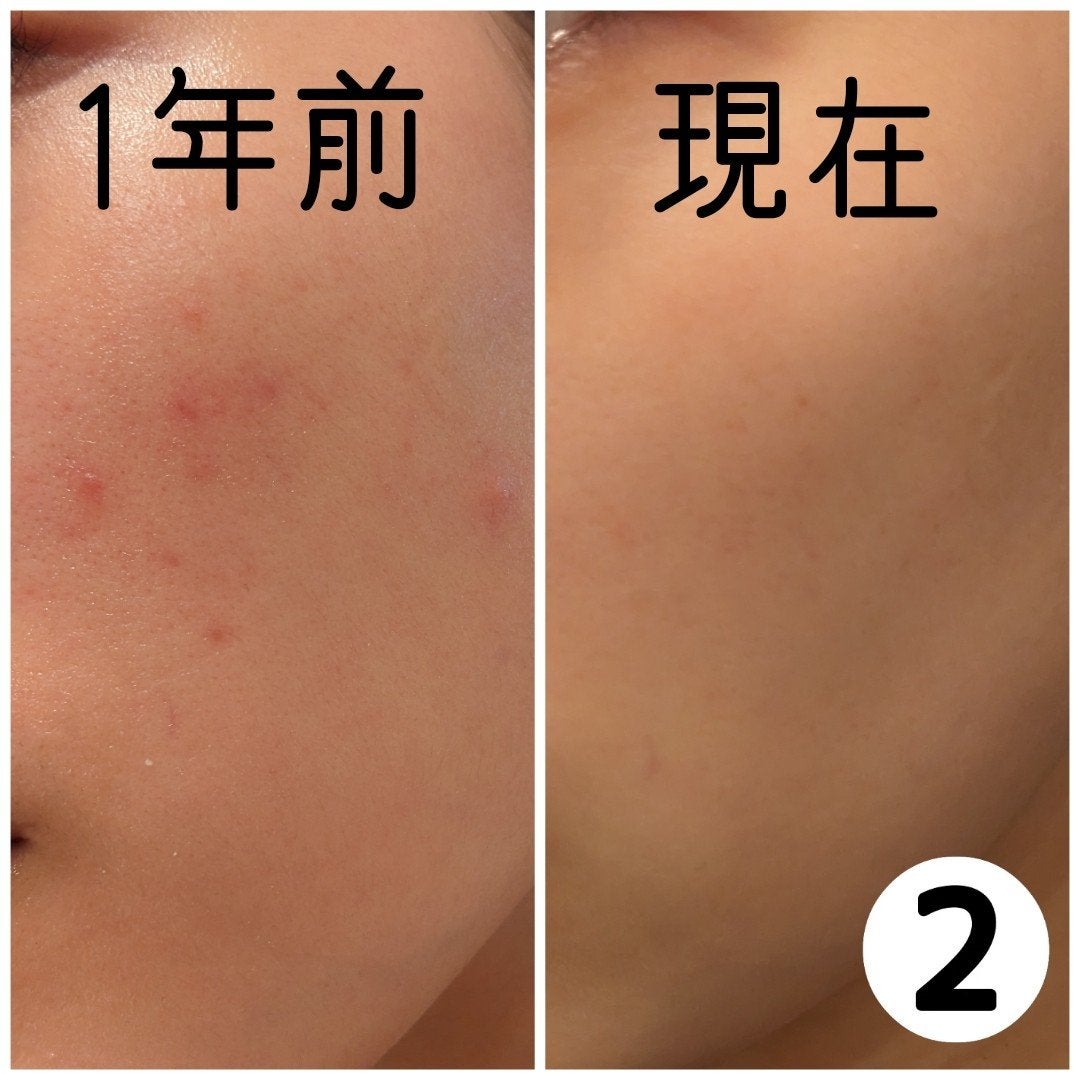 もか【スキンケア】 on LIPS 「【肌荒れが無理すぎて鏡見るのも出かけるのも全瞬間自己嫌悪に陥る..」(4枚目)