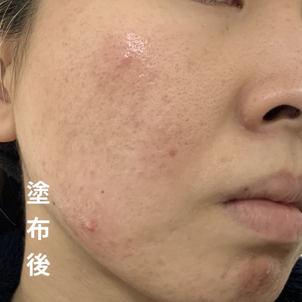 マジックティーツリーオイル/ブラン/フェイスオイルを使ったクチコミ（3枚目）