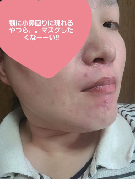 ティーツリーカーミングエッセンスパッド/MEDIHEAL/トナーパッドを使ったクチコミ(4枚目)