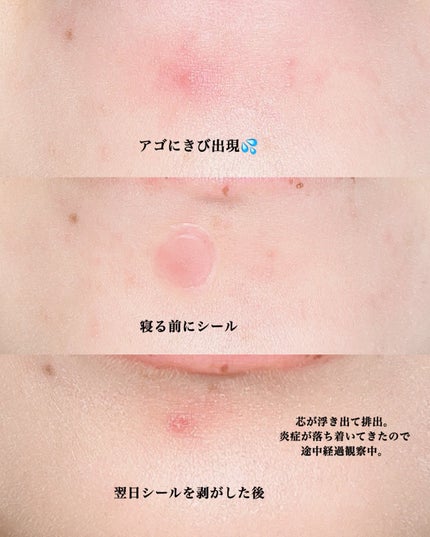 ビューティー スポットパッチ/イージーダムビューティー/にきびパッチを使ったクチコミ(4枚目)