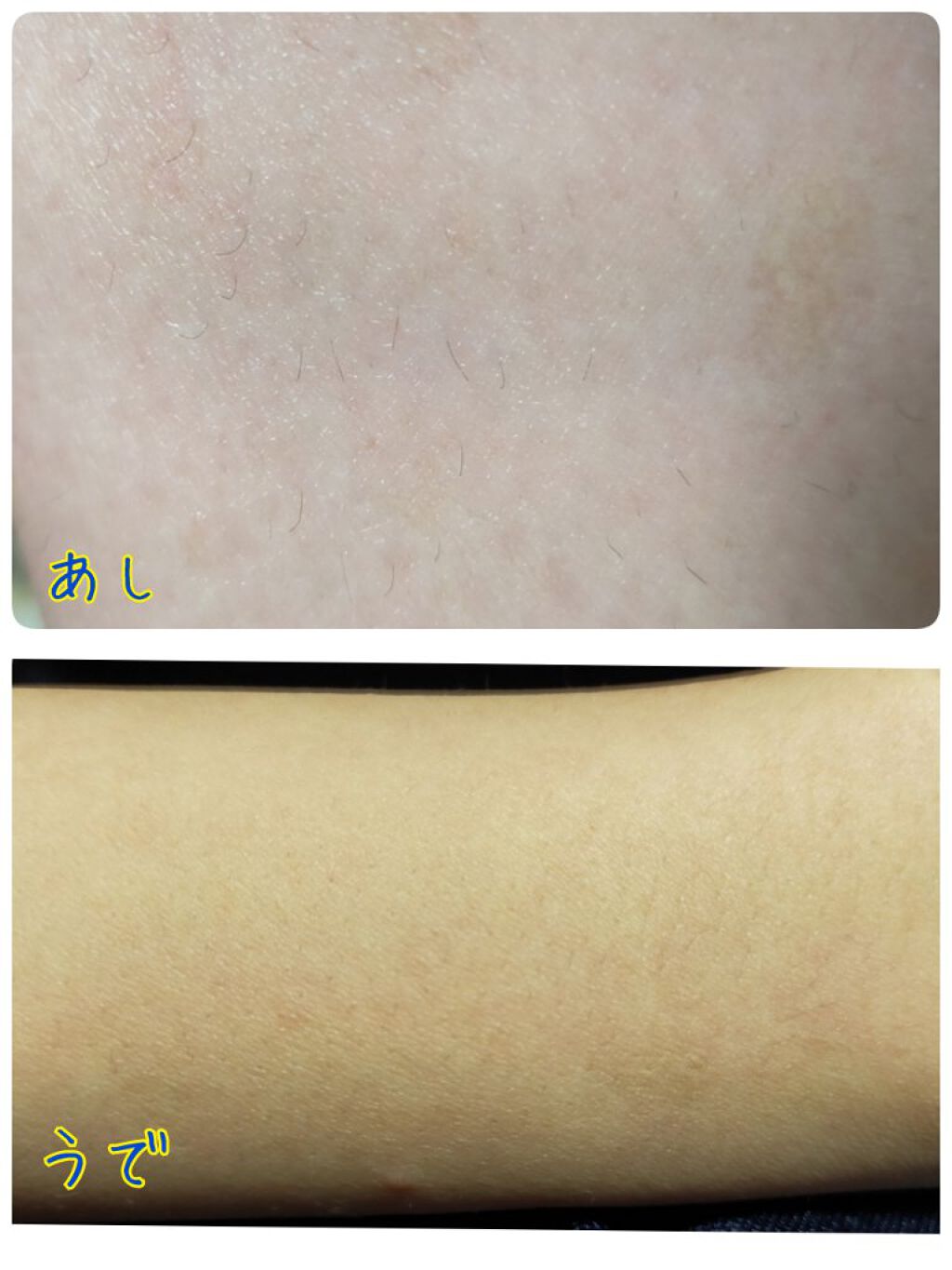 光脱毛器 VIO/Sarlisi/家庭用脱毛器を使ったクチコミ（2枚目）