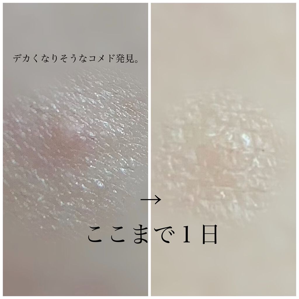 ペアアクネクリームW(医薬品)/ペア/その他を使ったクチコミ(2枚目)