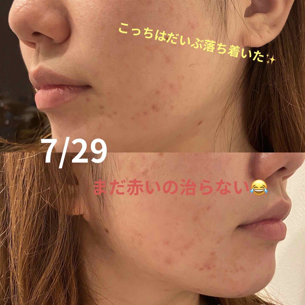 クリアアクネスポッツ/オルビス/美容液を使ったクチコミ(1枚目)