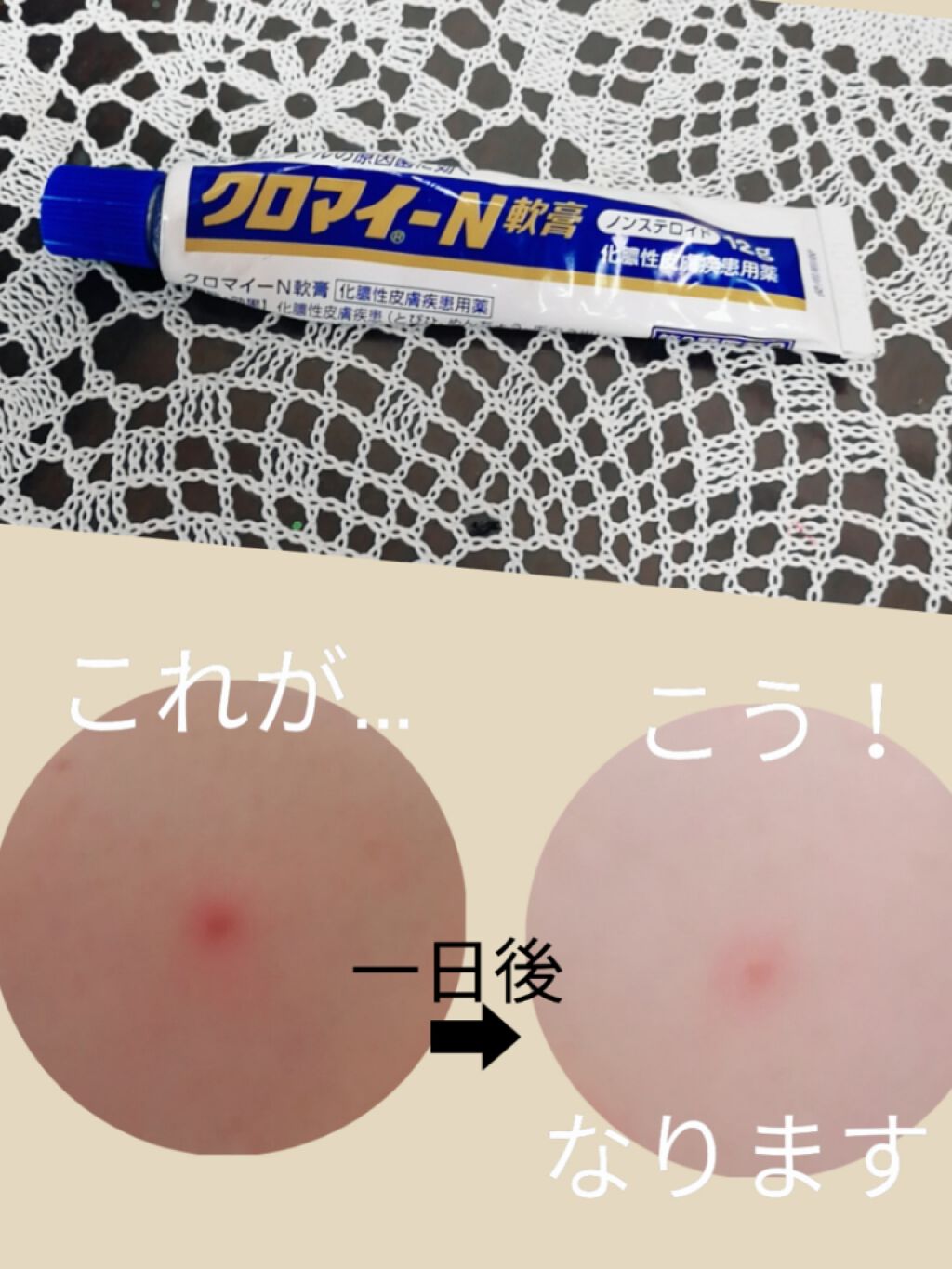 クロマイ-N軟膏(医薬品)/第一三共ヘルスケア/その他を使ったクチコミ(1枚目)