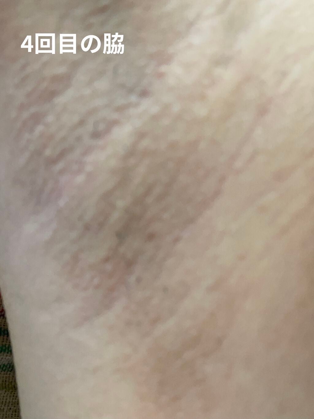FASIZ HAIR REMOVAL 家庭用脱毛器/FASIZ/家庭用脱毛器を使ったクチコミ(9枚目)