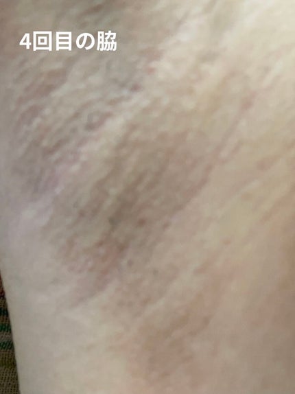 FASIZ HAIR REMOVAL 家庭用脱毛器/FASIZ/家庭用脱毛器を使ったクチコミ(9枚目)