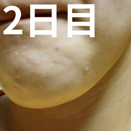 ゼロスポットパッチ/Today’s Cosme/にきびパッチを使ったクチコミ(2枚目)