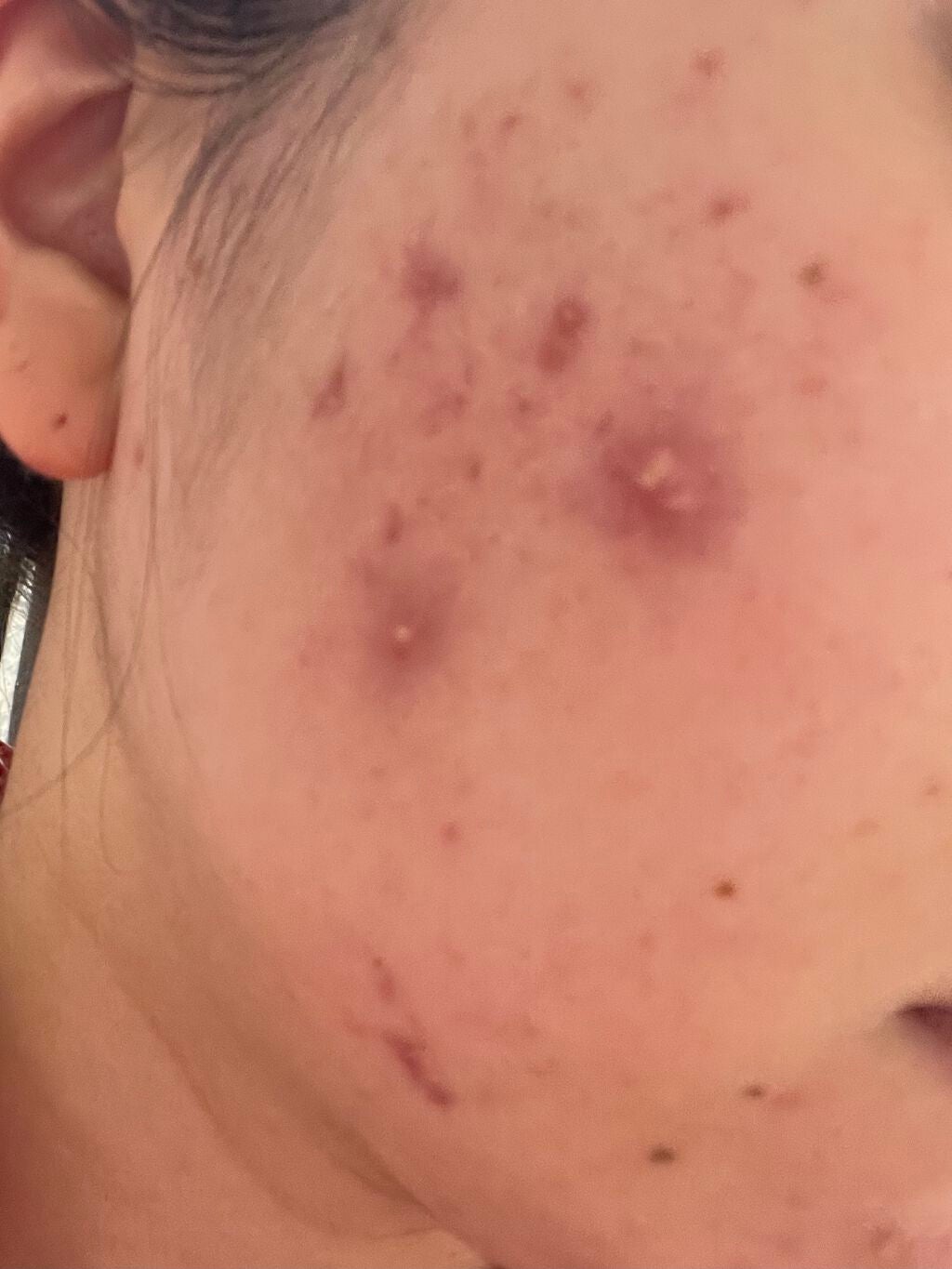 皮脂トラブルケア 保湿ジェル/キュレル/化粧水を使ったクチコミ(1枚目)