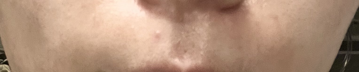 極薄透明パッチ nikipa!/金冠堂/にきびパッチを使ったクチコミ（2枚目）