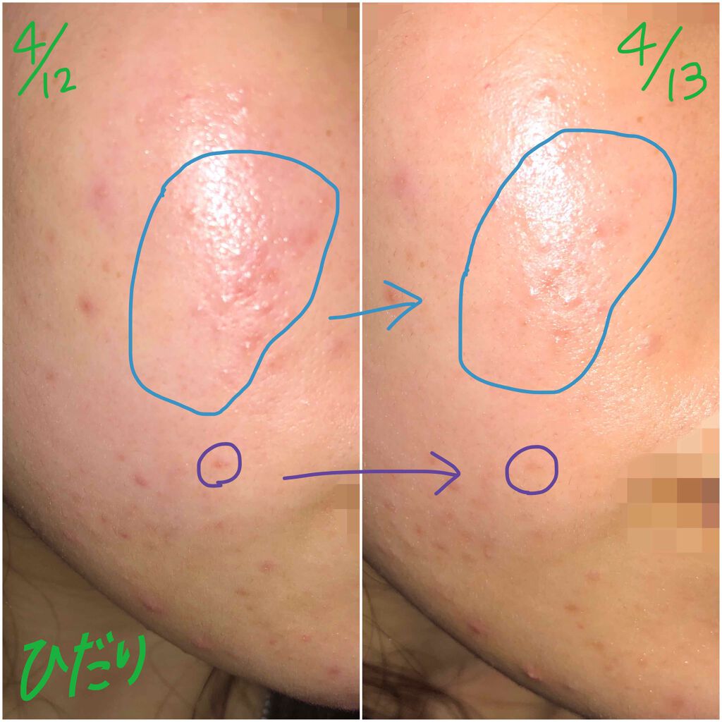 薬用 しみ 集中対策 美容液/メラノCC/美容液を使ったクチコミ（2枚目）