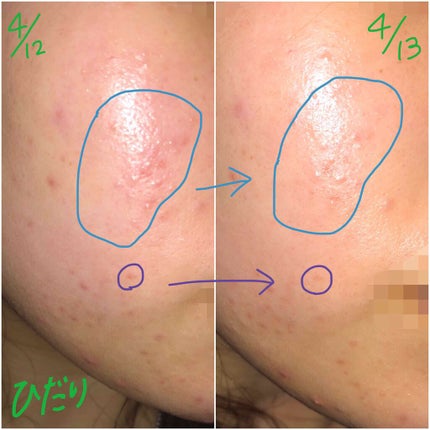 薬用 しみ 集中対策 美容液/メラノCC/美容液を使ったクチコミ(2枚目)