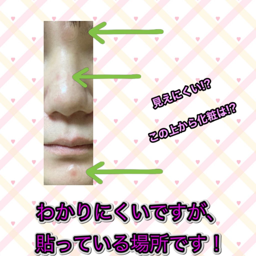 ゼロスポットパッチ/Today’s Cosme/にきびパッチを使ったクチコミ（2枚目）