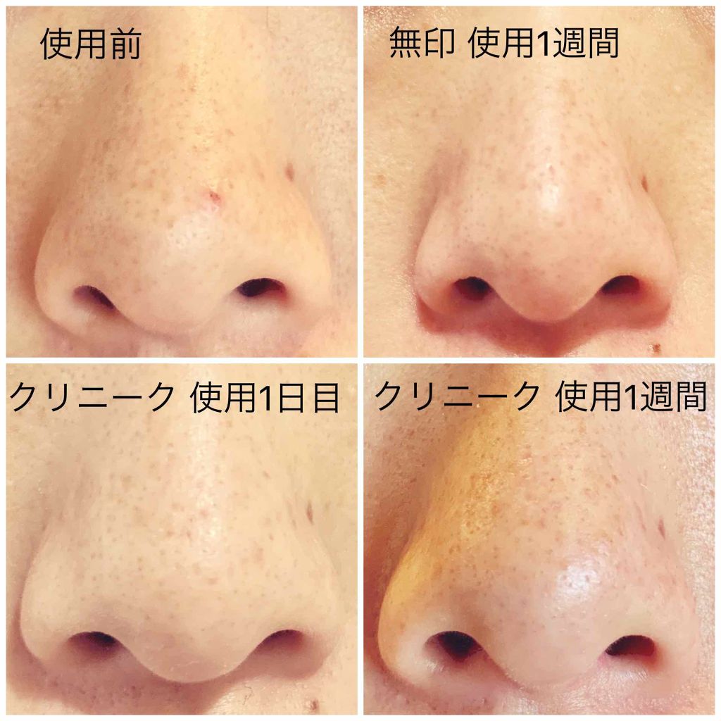 クラリファイング ローション 2/CLINIQUE/拭き取り化粧水を使ったクチコミ（2枚目）