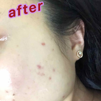 ティーツリーケアソリューション アンプルマスクJEX/MEDIHEAL/シートマスク・パックを使ったクチコミ(3枚目)