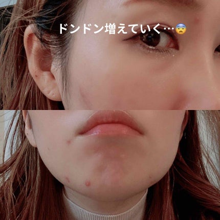 ペアアクネクリームW(医薬品)/ペア/その他を使ったクチコミ(2枚目)