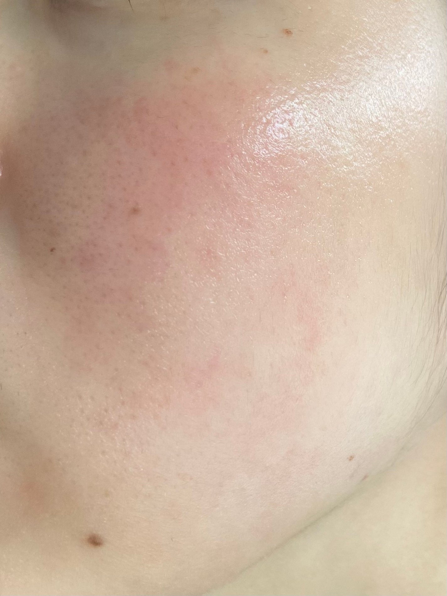 あかね on LIPS 「記録用(5/2)1週間前に皮膚科に行ってきました。ロゼックスゲ..」(2枚目)