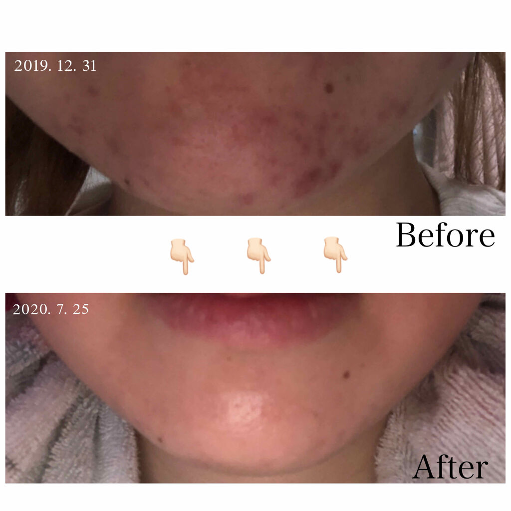 クリアトライアルセット M（しっとりタイプ）/オルビス/トライアルキットを使ったクチコミ（1枚目）