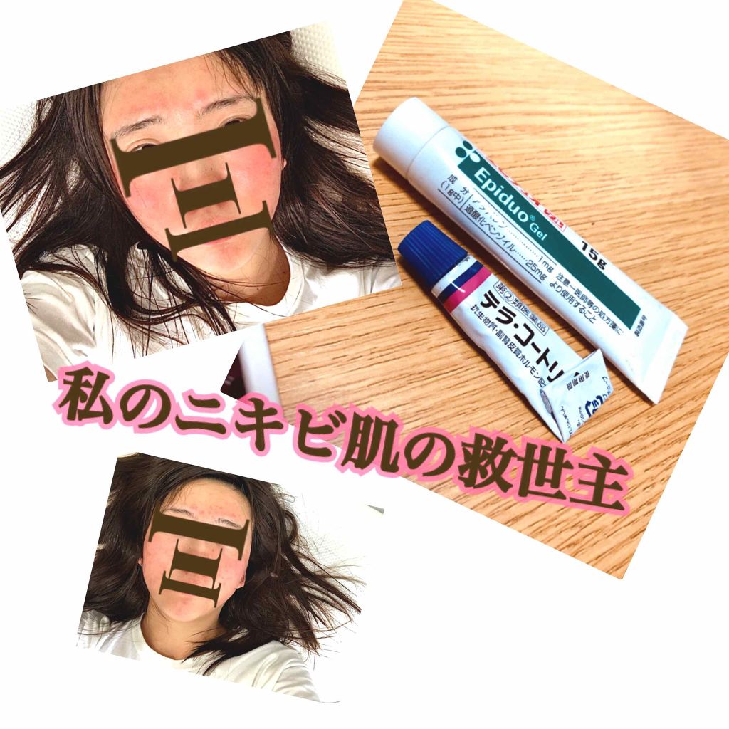 テラ・コートリル 軟膏(医薬品)/ジョンソン・エンド・ジョンソン/その他を使ったクチコミ(1枚目)