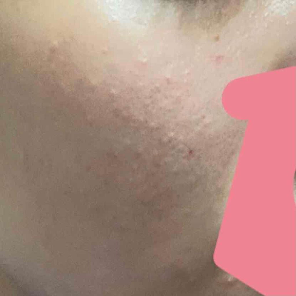 クラーク on LIPS 「赤ニキビは皮膚科でもらった薬でなんとかこの感じですが全く治りま..」(2枚目)