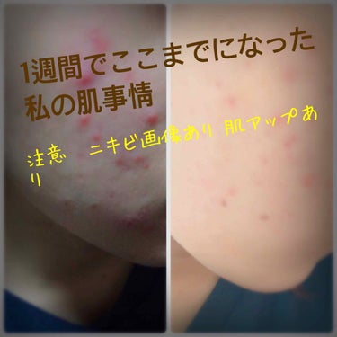 薬用3ステップセット30日サイズ|プロアクティブを使った口コミ - 注意