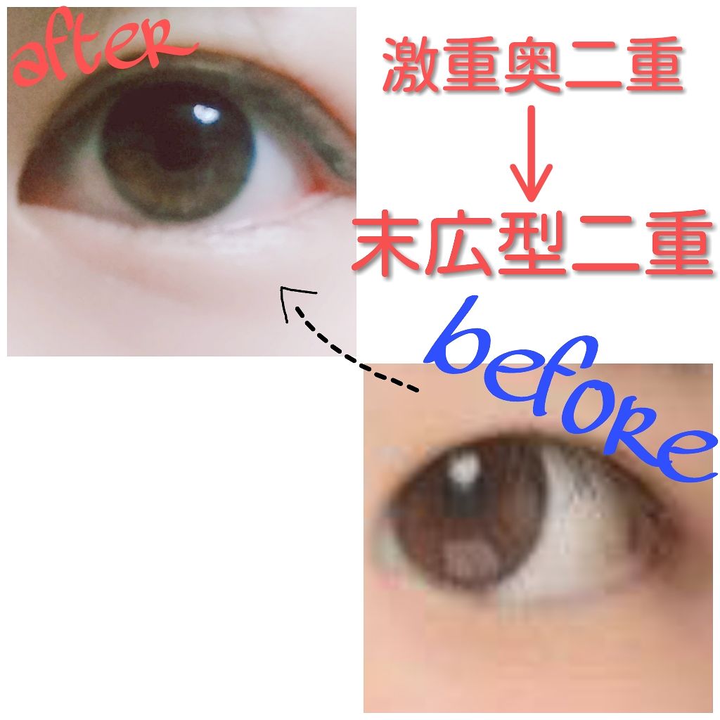 のびーるアイテープ(絆創膏タイプ、レギュラー)/DAISO/二重まぶた用アイテムを使ったクチコミ(1枚目)