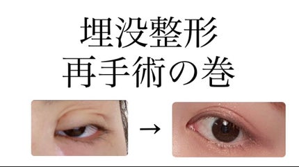 あやか on LIPS 「二重の埋没手術をしようか悩んでいる方ダウンタイム中の方ぜひご覧..」(1枚目)