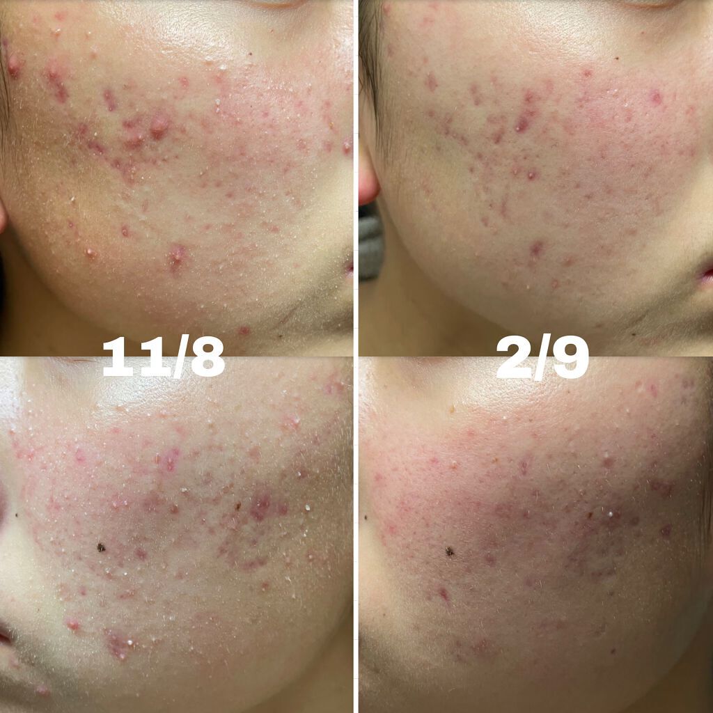 3番 すべすべキメケアセラム/numbuzin/美容液を使ったクチコミ（1枚目）