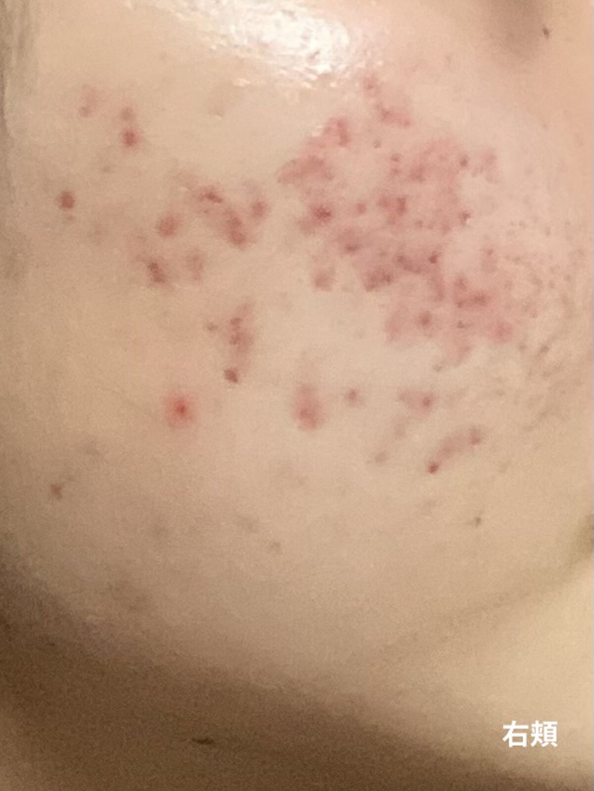 AHA 30% + BHA 2% Peeling Solution/The Ordinary/ピーリングを使ったクチコミ（2枚目）