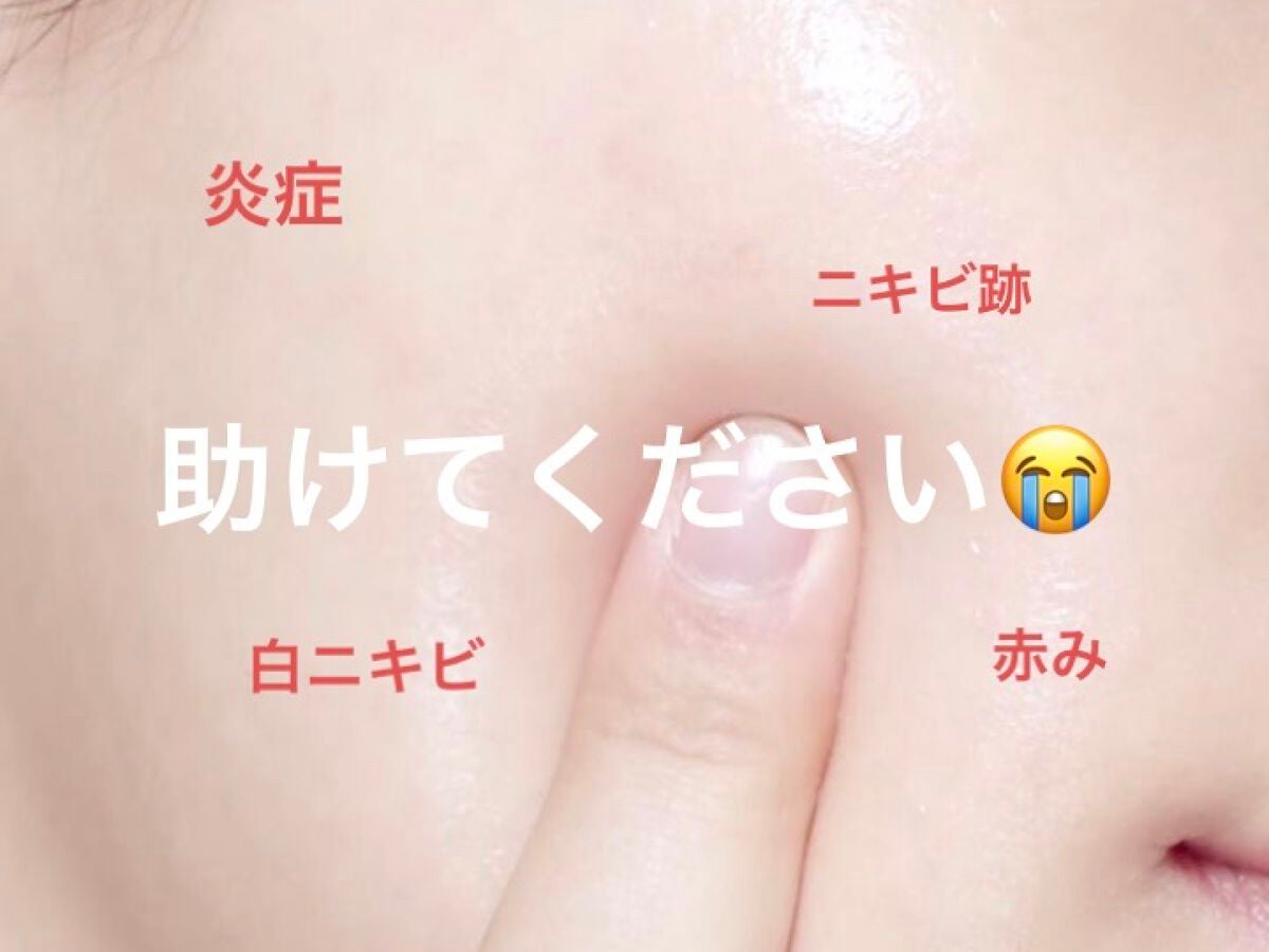 枝豆 on LIPS 「こんな肌と付き合って3年です💧効くと聞いたスキンケア試してきて..」(1枚目)