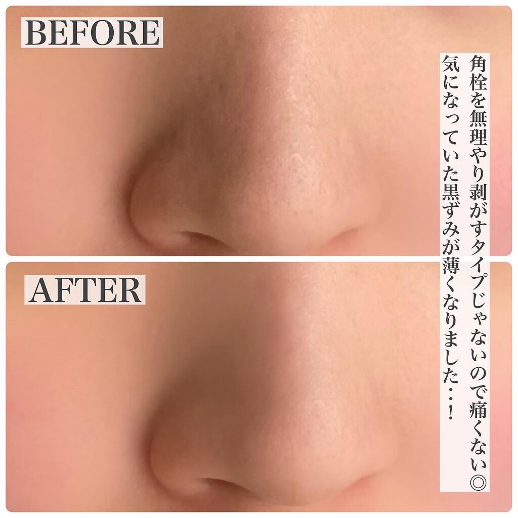 ブラックヘッドクリア2ステップノーズパッチ/DPU/シートマスク・パックを使ったクチコミ(4枚目)