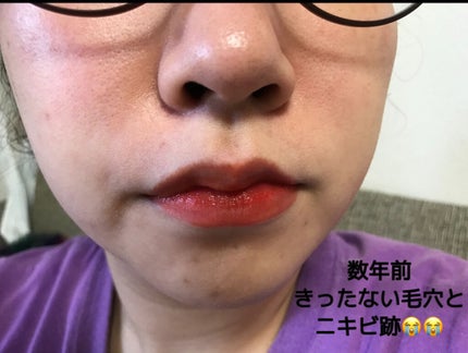 プラセンタ原液/ナチュラス/美容液を使ったクチコミ(2枚目)