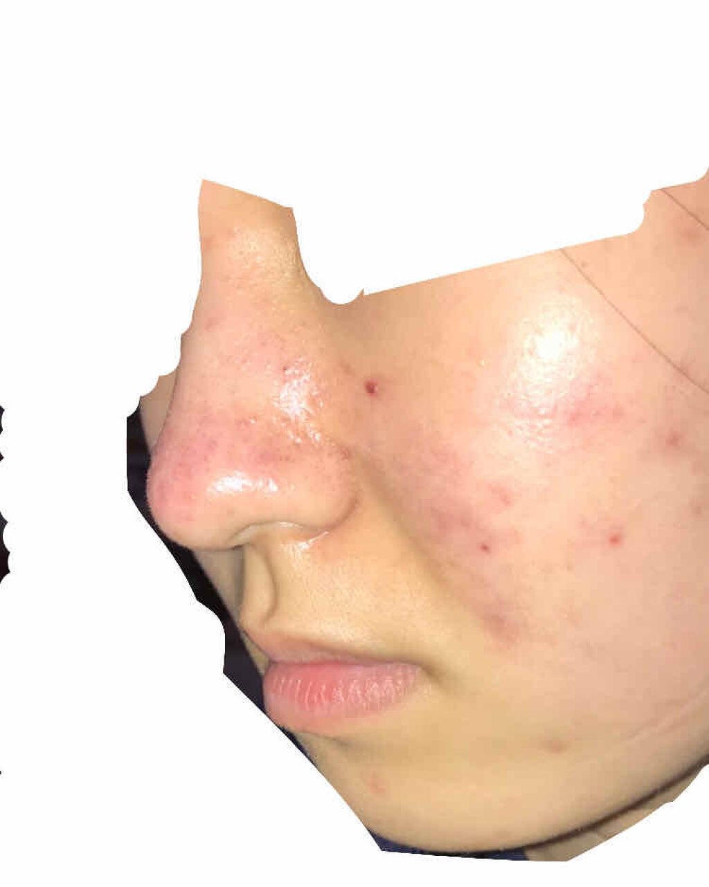 ノブ Ａ アクネソープ/NOV/洗顔石鹸を使ったクチコミ（3枚目）