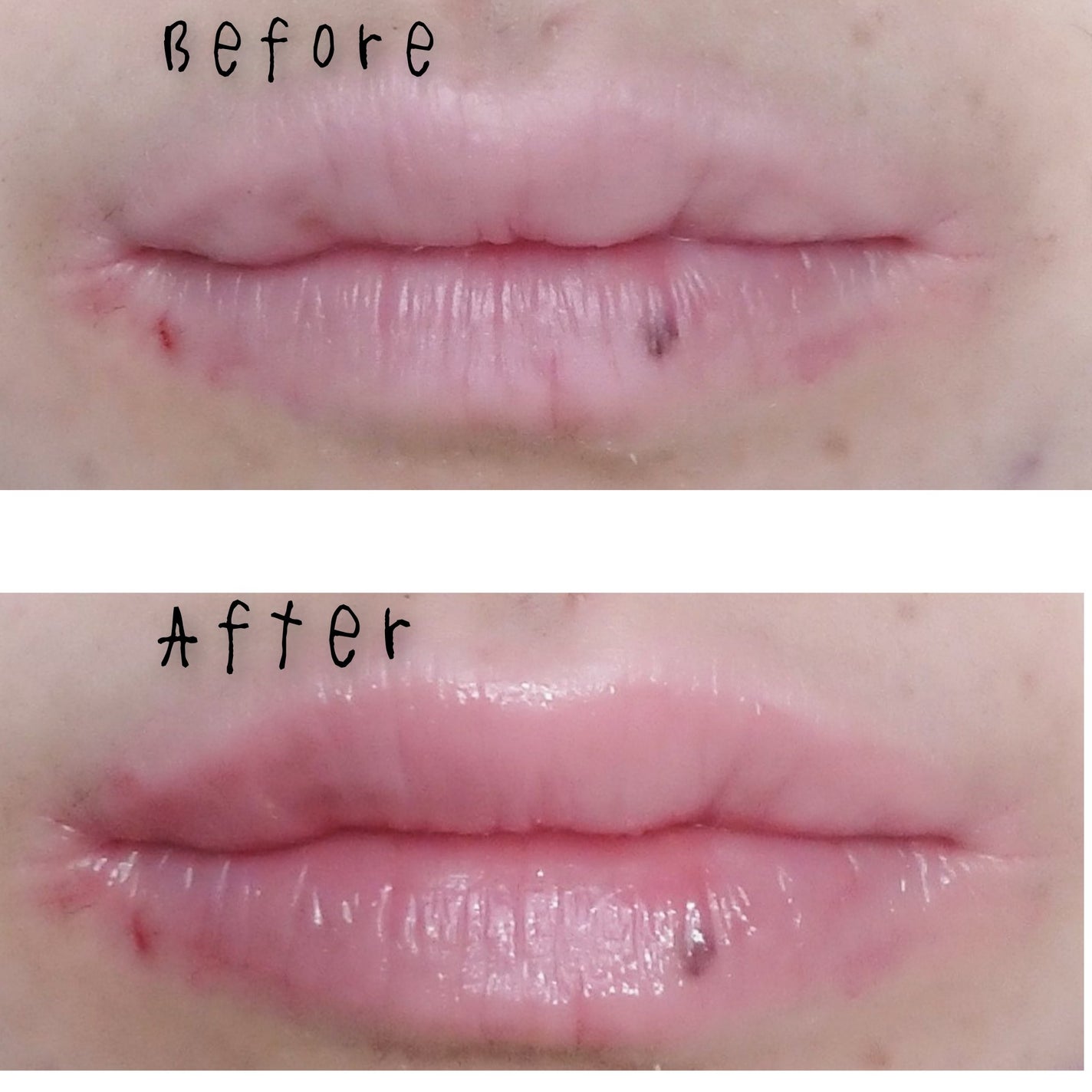 ニードルプランパー 高熱フィグ/Ui2./リッププランパーを使ったクチコミ(6枚目)