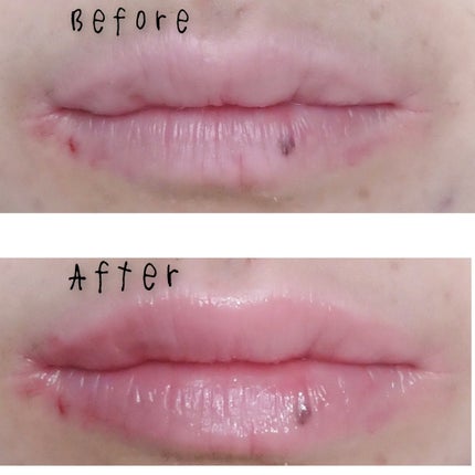 ニードルプランパー 高熱フィグ/Ui2./リッププランパーを使ったクチコミ(6枚目)