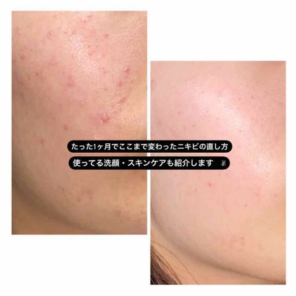 ノブ A アクネソープ/NOV/洗顔石鹸を使ったクチコミ(1枚目)